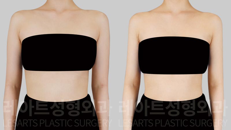 arm-liposuction-02-02-260804