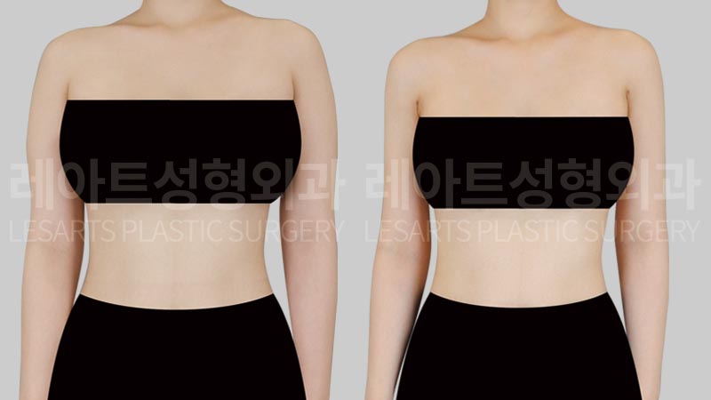 arm-liposuction-02-02-260806