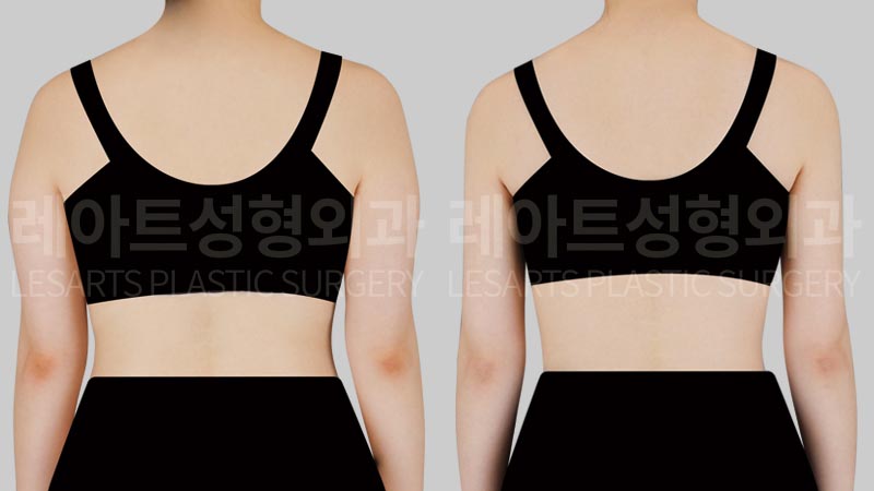 arm-liposuction-02-03-260723