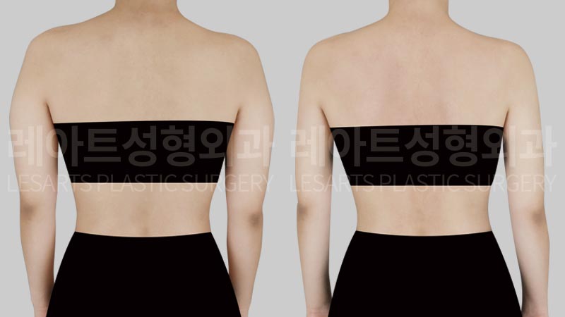 arm-liposuction-02-03-260803