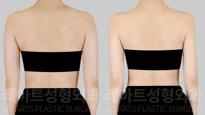 arm-liposuction-02-03-260804
