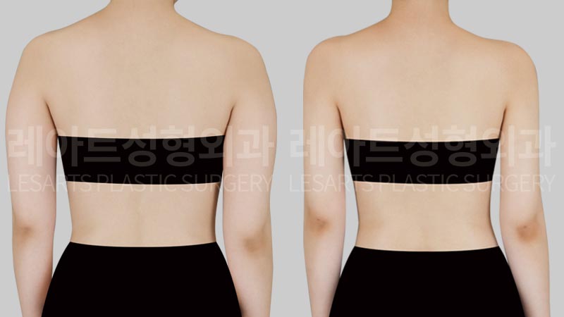 arm-liposuction-02-03-260806