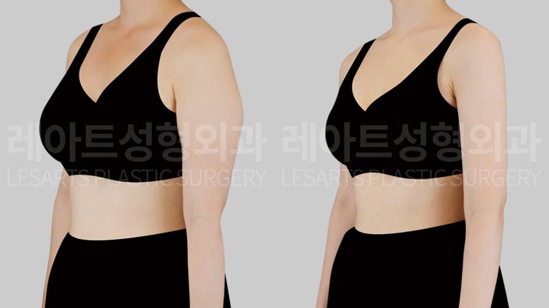 arm-liposuction-02-04-260723