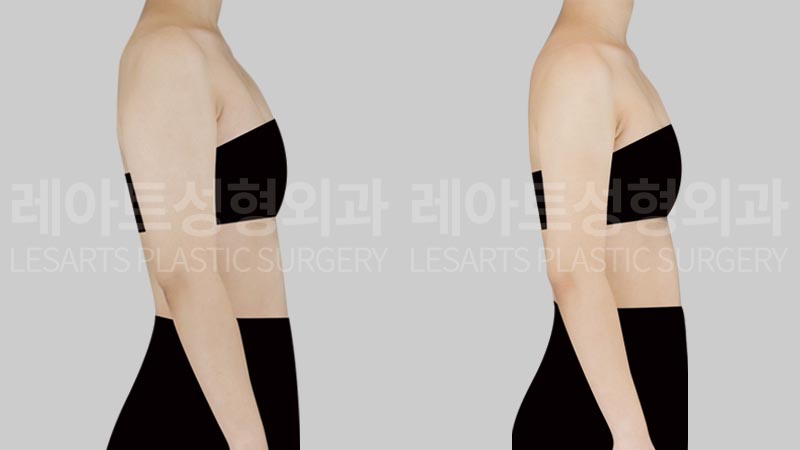 arm-liposuction-02-04-260803