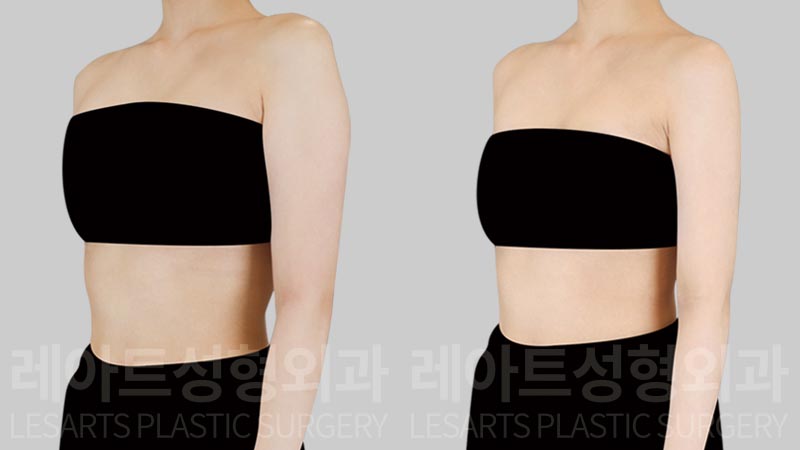 arm liposuction before after - lesarts plastic surgery