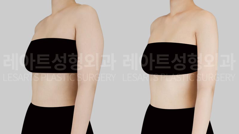 arm liposuction before after - lesarts plastic surgery