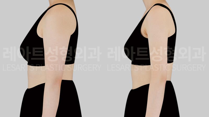 arm liposuction before after - lesarts plastic surgery