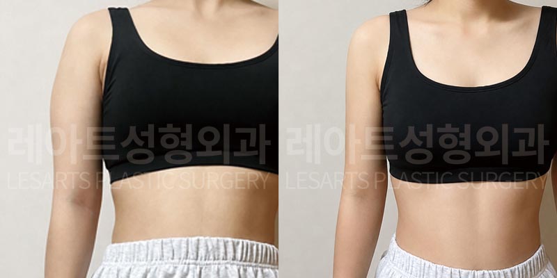 arm-liposuction-02-05-260803