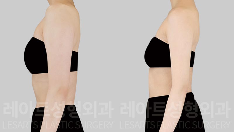 arm-liposuction-02-05-260804