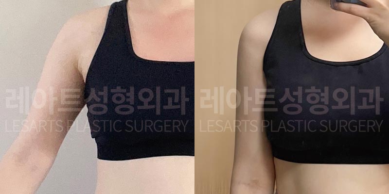 arm-liposuction-02-06-260723