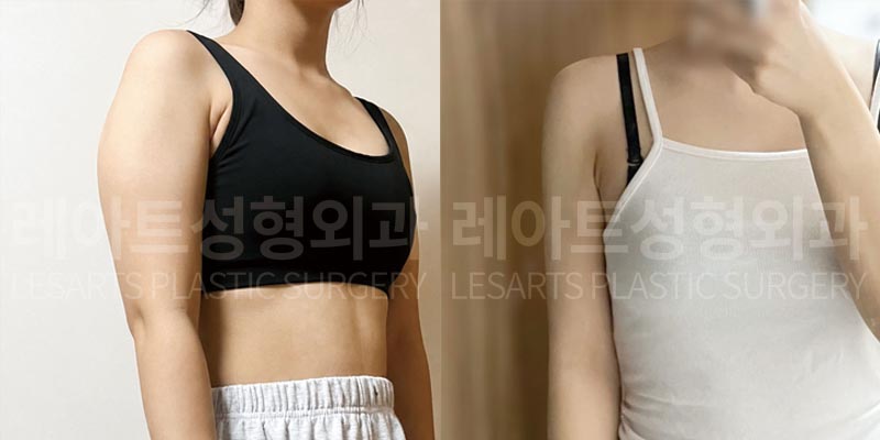 arm-liposuction-02-06-260803
