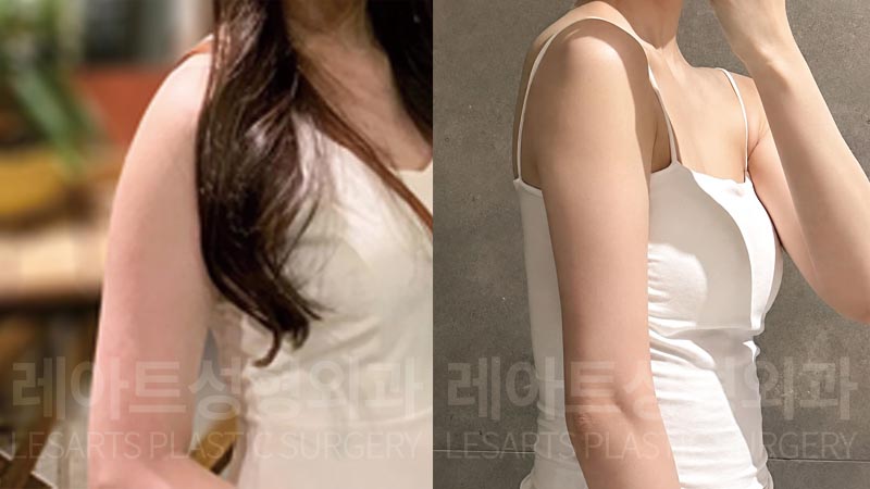 arm-liposuction-02-06-260804