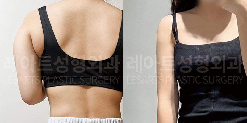 arm-liposuction-02-07-260803