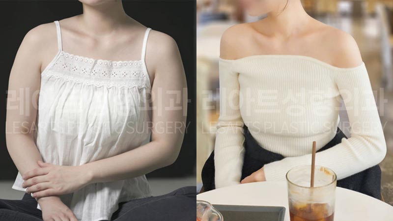 arm-liposuction-02-07-260806