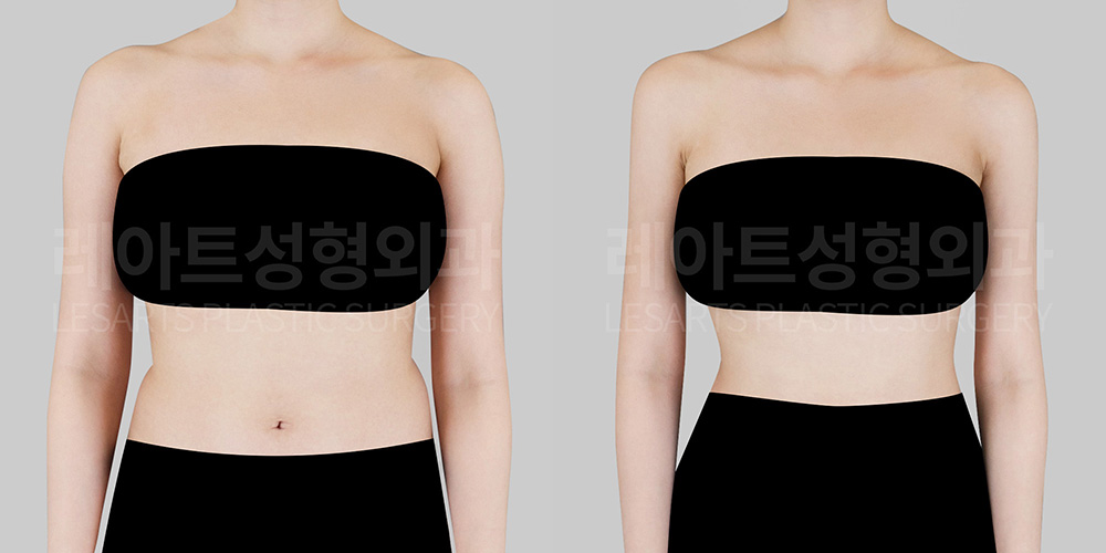 arm-liposuction-before-after-lesarts