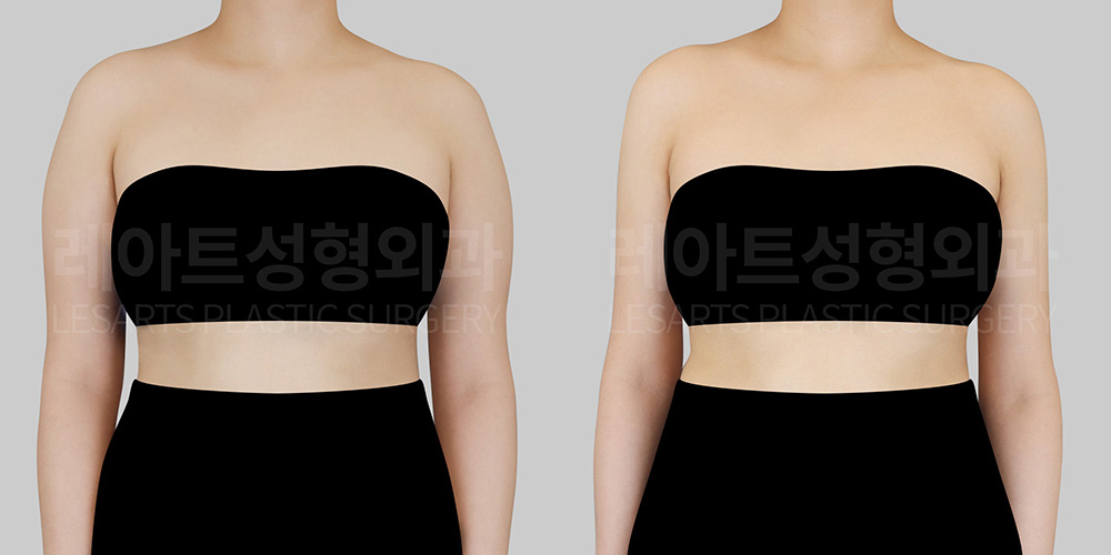 lesarts arm liposuction before after