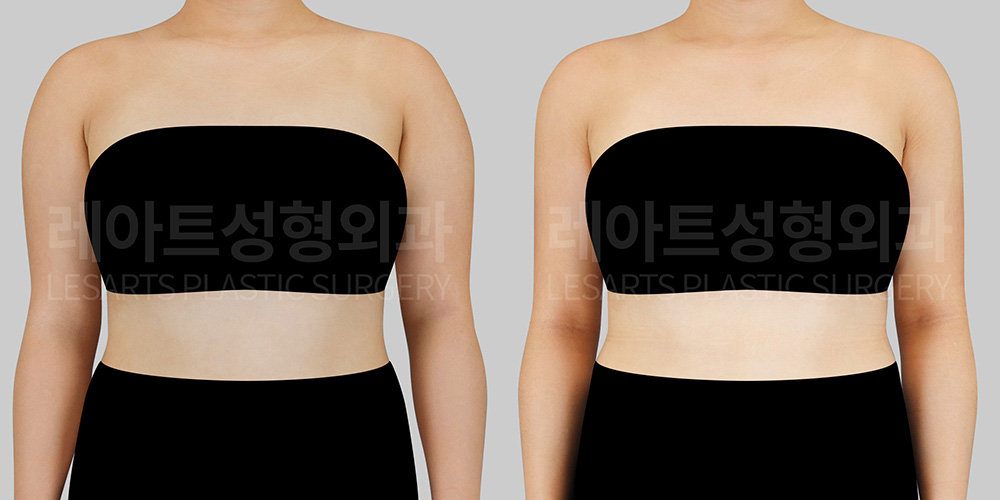 lesarts arm liposuction before after