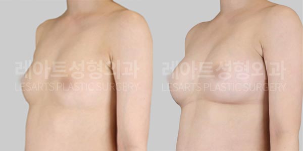 lesarts breast fat transfer before and after