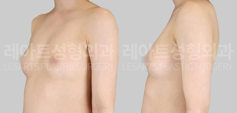 breast-fat-transfer-02-01-260716