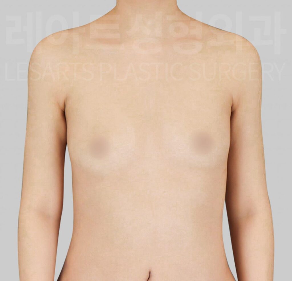 breast-fat-transfer-02-01-260811