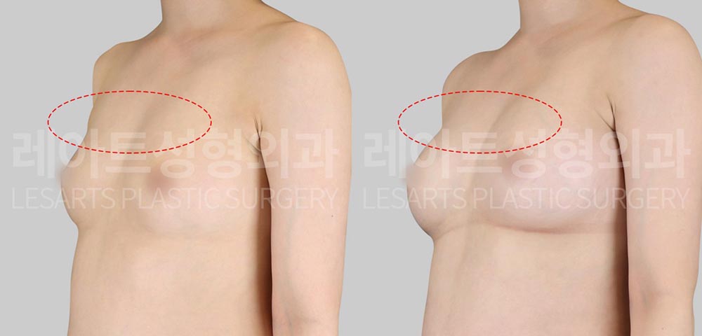 breast-fat-transfer-02-02-260716