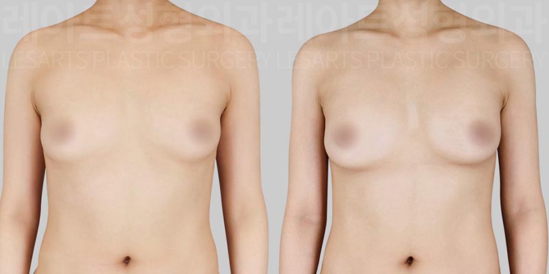 breast-fat-transfer-02-02-260728