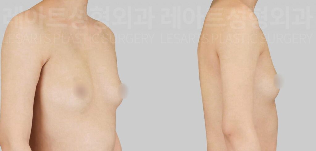 breast-fat-transfer-02-02-260811