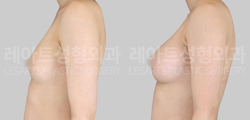 breast-fat-transfer-02-03-260716
