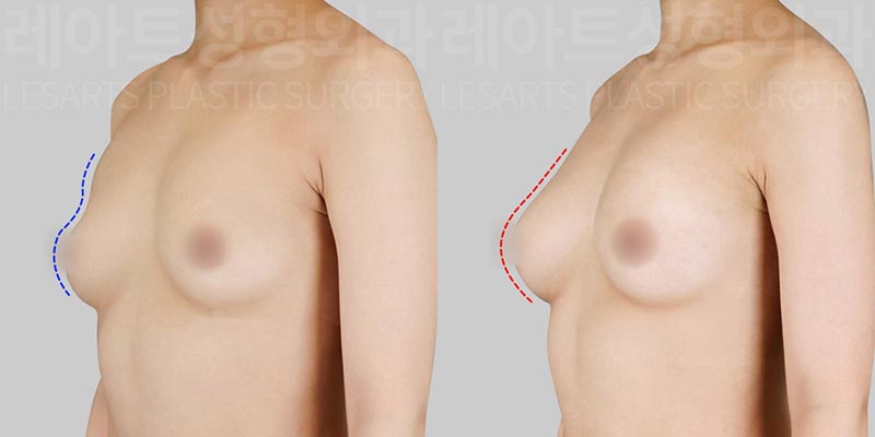lesarts breast fat transfer before and after