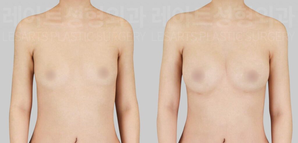 Breast fat transfer in Korea: upper breast volume and shape changes at 3 months