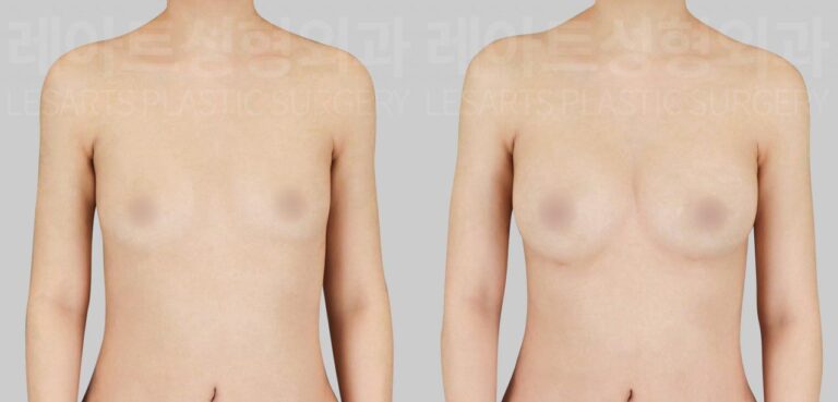 lesarts breast fat transfer before and after