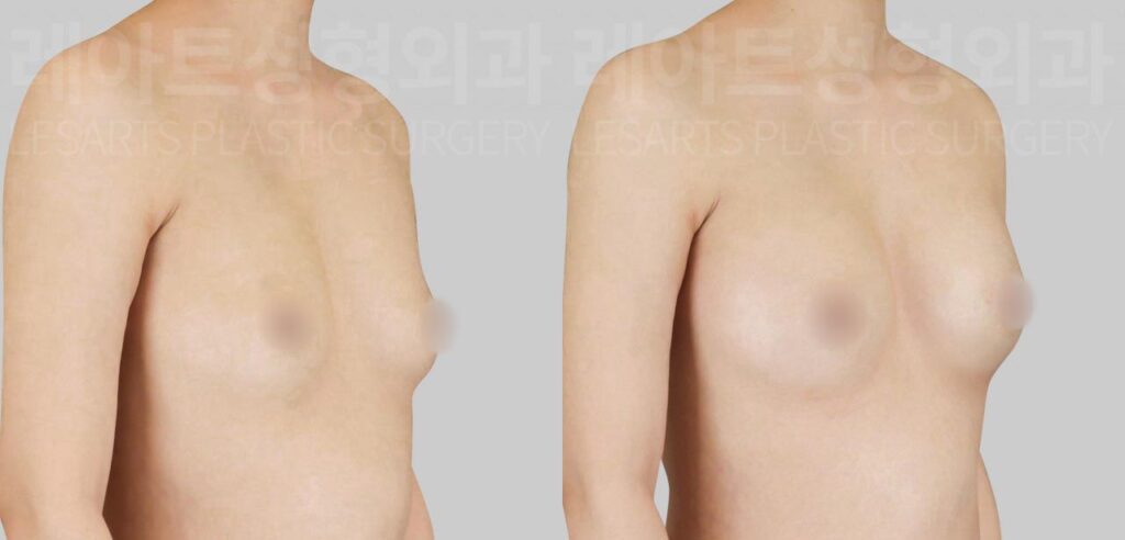 breast-fat-transfer-02-04-260811