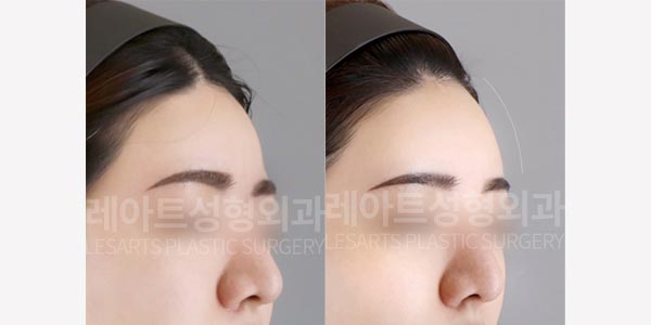 lesarts facial fat grafting before and after