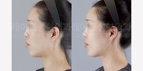 lesarts facial fat grafting before and after