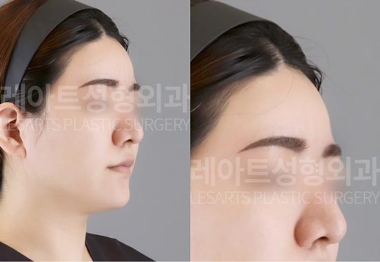 facial-fat-transfer-02-01-260130