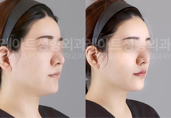 facial-fat-transfer-02-02-260130
