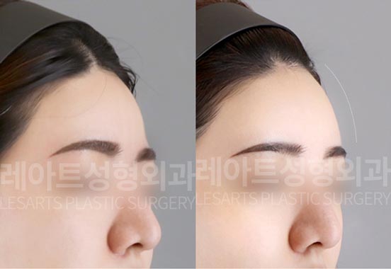 facial-fat-transfer-02-03-260130