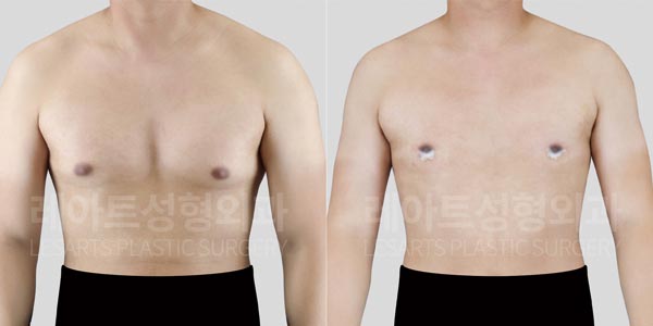 lesarts gynecomastia before and after