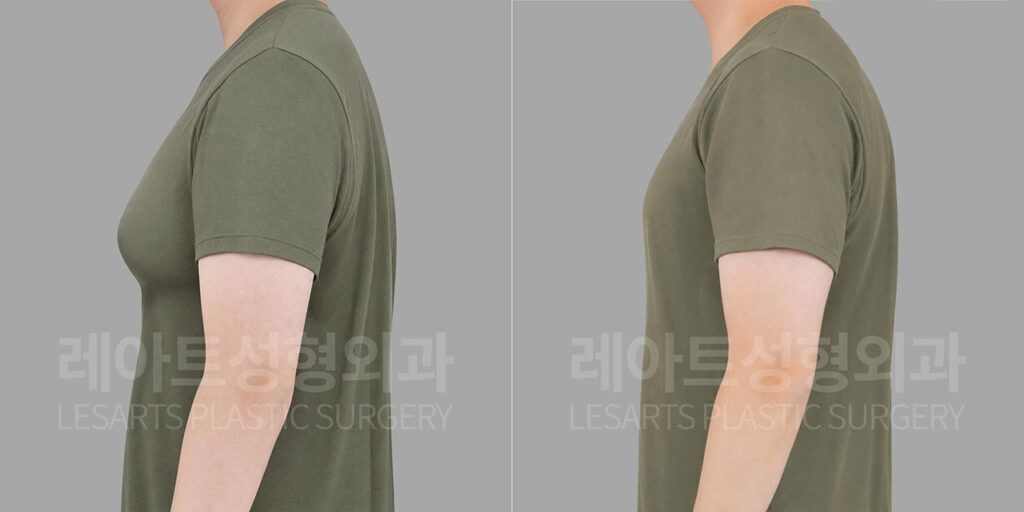 Gynecomastia surgery in Korea for military personnel: 2-week changes in chest protrusion seen through a T-shirt