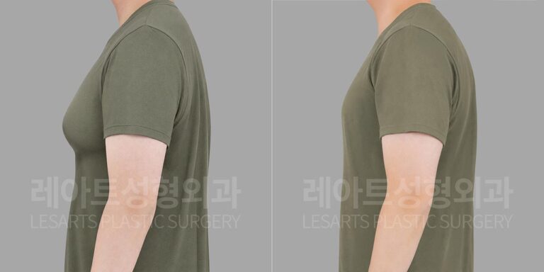 lesarts gynecomastia before and after