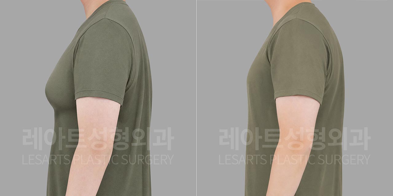 lesarts gynecomastia before and after