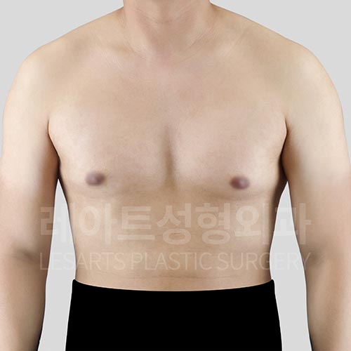 gynecomastia-02-01-260720