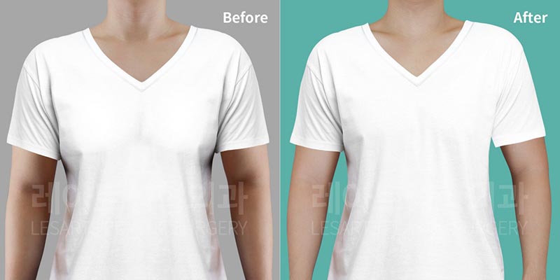 gynecomastia-02-01-260729