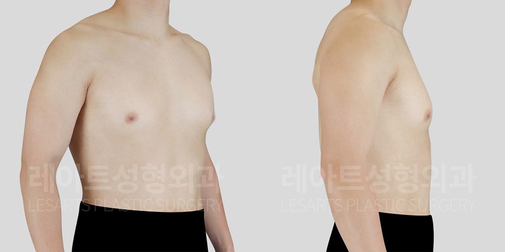 gynecomastia-02-01-260803
