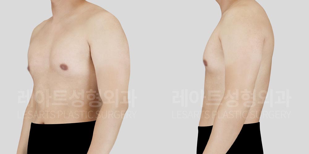 gynecomastia-02-02-260720