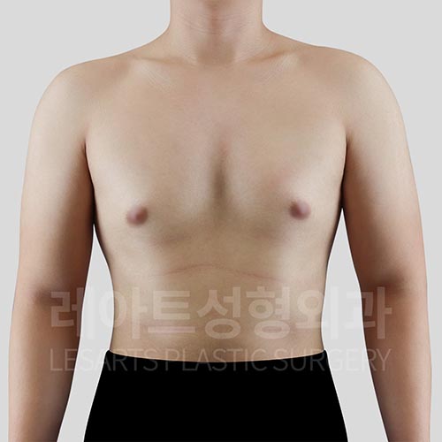 gynecomastia-02-02-260729