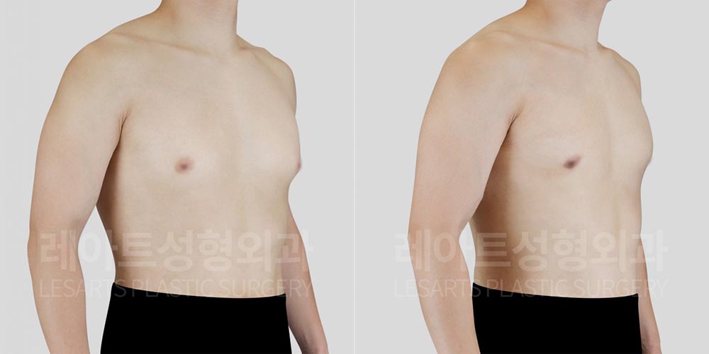 lesarts gynecomastia before and after