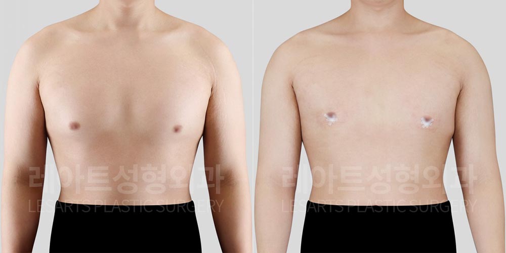 lesarts gynecomastia before and after