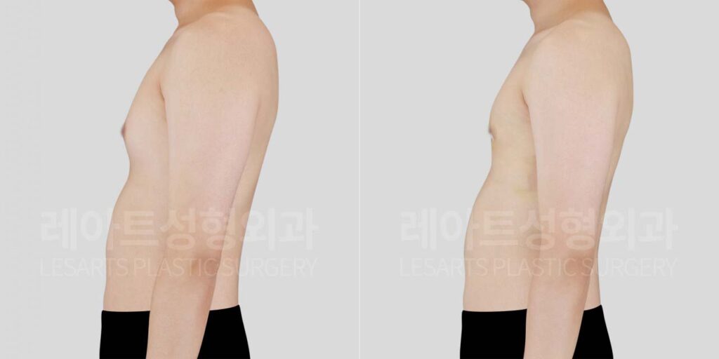 Male gynecomastia in Seoul: why ultrasound is important when you feel a lump in the chest