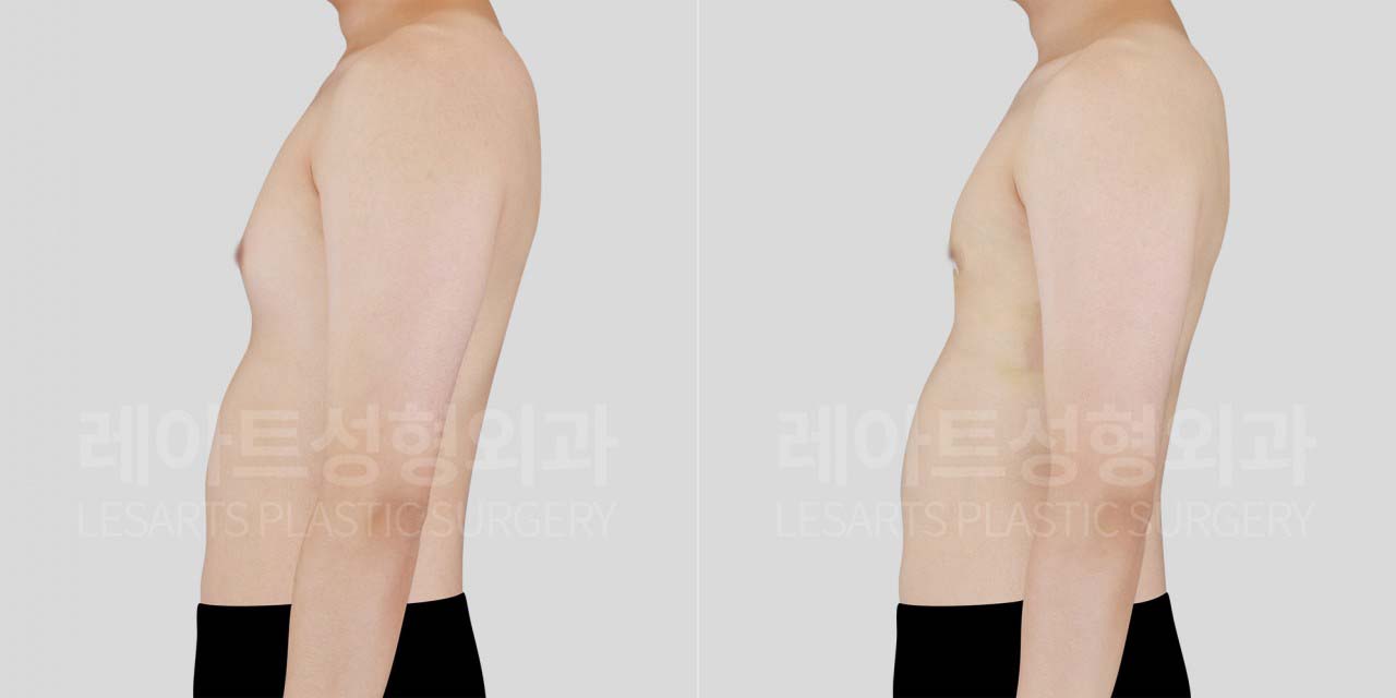 lesarts gynecomastia before and after
